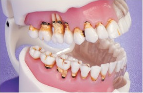 Gum Care